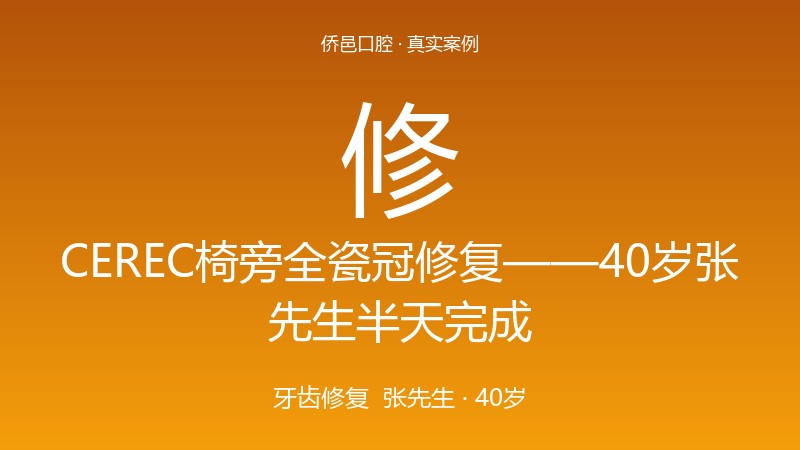 CEREC椅旁全瓷冠修复——40岁张先生半天完成